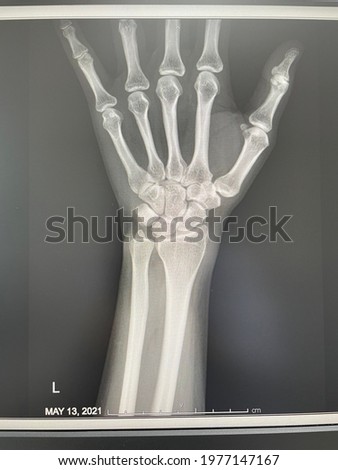 X-ray film of human hand skeleton with date and label to explain side and position 