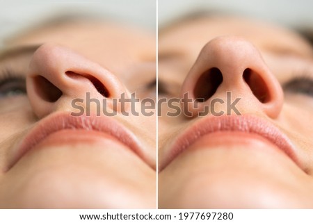 Before After Young Woman Aesthetic Facelift. Rhinoplasty Nose Surgery Royalty-Free Stock Photo #1977697280