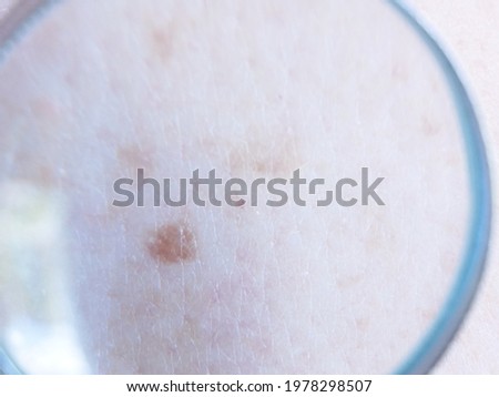 doctor dermatologist examines birthmark of patient. Checking benign moles closeup