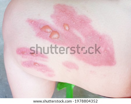 Asian woman blistered and red skin from accidental scalds. Royalty-Free Stock Photo #1978804352