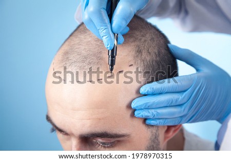 Patient suffering from hair loss in consultation with a doctor. Doctor using skin marker Royalty-Free Stock Photo #1978970315