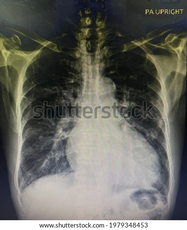 The picture of chest x-ray of patient who have bilateral pneumonia , Medical Technology and Science concept.