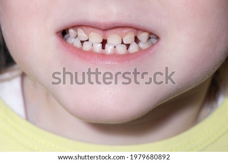 little girl with open mouth and baby teeth. The concept of proper care for the oral cavity and baby teeth in children, close-up. Dentist