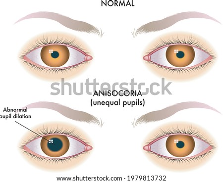 Medical illustration of symptoms of unequal pupils called anisocoria, with annotations. Royalty-Free Stock Photo #1979813732