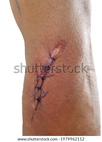 Surgical wound on the arm from an accident placed on a white background