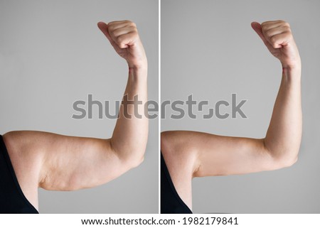 Obesity Cellulite And Fat Removal Surgery Before And After Royalty-Free Stock Photo #1982179841