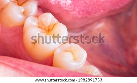 Symptoms of demineralization of the teeth. Visible signs of caries in the interstices of the enamel of  the tooth. Dental damaged erosion concept. Loss of the reinforcement of the enamel.  Royalty-Free Stock Photo #1982891753