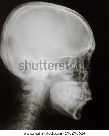 X-ray : Lateral skull