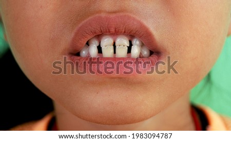 A girl with a space between teeth and Extension or bulging out (protrusion) of the lower jaw (mandible). It occurs when the teeth are not properly aligned.  Royalty-Free Stock Photo #1983094787