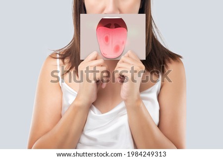 The woman show the picture of tongue problems, Illustration benign migratory glossitis on a brown paper, Behcet's Disease Royalty-Free Stock Photo #1984249313