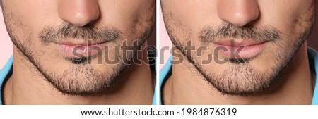 Collage with photos of man before and after lips augmentation, closeup. Banner design Royalty-Free Stock Photo #1984876319
