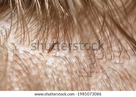 Dead lice in a child's hair after disinfection