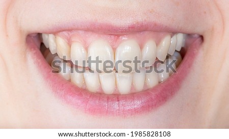 Symptoms of demineralization of the teeth. Visible signs of transparency of the tooth. Dental damaged erosion concept. Loss of the reinforcement of the enamel. Royalty-Free Stock Photo #1985828108