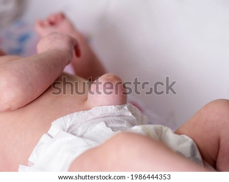 Large umbilical hernia in premature newborn baby Royalty-Free Stock Photo #1986444353