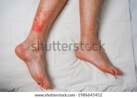 Male leg, itching and red rash caused by insect bites and bites. Health and medical surveillance and concept development.