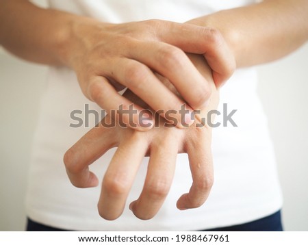 Asian hand muscle spasm . Disorder of one hand. abnormally bent fingers on a white background. Royalty-Free Stock Photo #1988467961