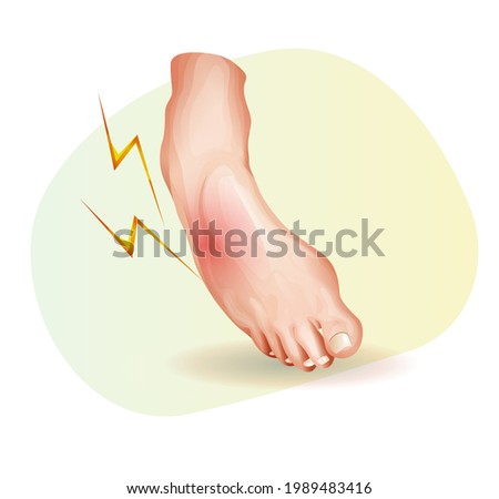 Elastic bandage for Ankle Sprain - Illustration as EPS 10 File