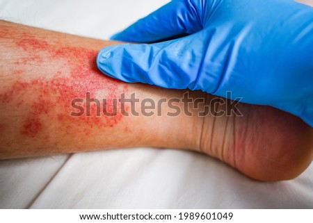 Disease of the skin on the legs, itchy red rashes and spots