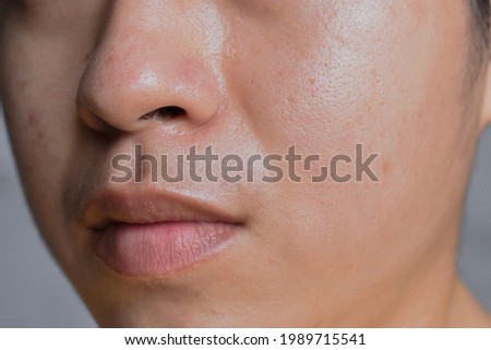 Oily skin with wide pores in face of Southeast Asian, Myanmar or Korean adult young man. Closeup view. Royalty-Free Stock Photo #1989715541