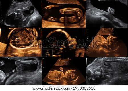 many ultrasound picture of a baby child