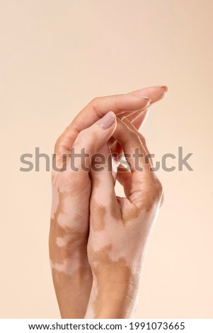 Young woman showing her vitiligo hands, Horizontal view  Royalty-Free Stock Photo #1991073665