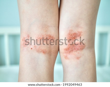 Eczema on kid's legs. Atopic dermatitis close up. Allergy spots and red itchy skin inflammation on child's feet Royalty-Free Stock Photo #1992049463