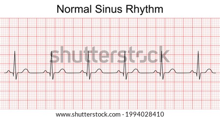Electrocardiogram show normal heart beat line (Sinus rhythm). ECG. EKG. Vital sign. Medical healthcare symbol. Royalty-Free Stock Photo #1994028410