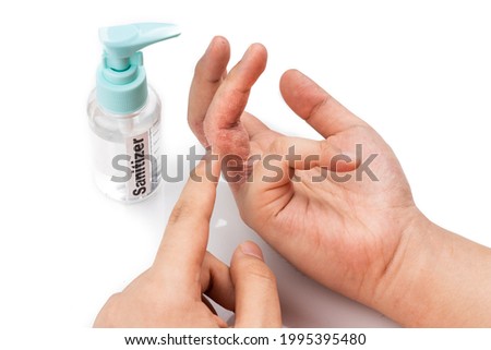 Dry skin finger with bottle of hand sanitizer. Sanitizer causes dryness with frequent use Royalty-Free Stock Photo #1995395480
