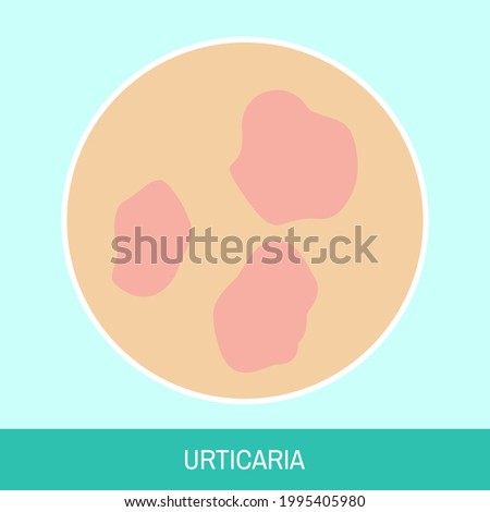 Closeup irritated skin vector illustration. Circle icon with urticaria and text sign. Image of skin with urticaria (hives) close up for medical articles, posters and banners.