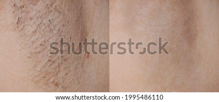 Close-up before and after skincare cosmetology armpits epilation treatment concept. Problem underarm chicken skin, Fox Fordyce, black armpit in woman texture background .  Royalty-Free Stock Photo #1995486110