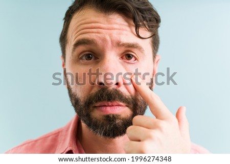 Portrait of a depressed young man suffering from red eyes. Sick hispanic man with conjunctivitis and allergies  Royalty-Free Stock Photo #1996274348