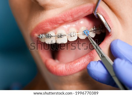 Close up of woman with brackets receiving dental braces treatment in clinic. Orthodontist using dental mirror and forceps while putting orthodontic braces on patient teeth. Concept of dentistry. Royalty-Free Stock Photo #1996770389