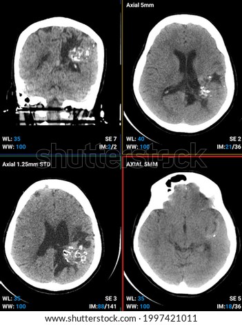 head ct arteriovenous malformation  radiology Royalty-Free Stock Photo #1997421011