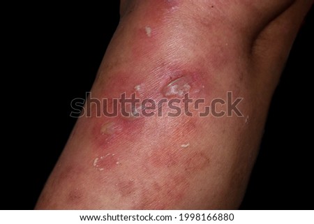 Staphylococcal, Streptococcal skin infection or bullous impetigo and cellulitis at leg of Asian patient. Isolated on black. Royalty-Free Stock Photo #1998166880