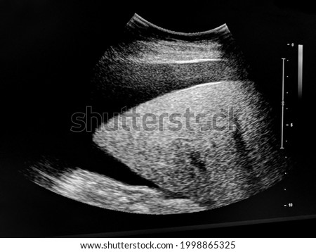 ultrasound examination of the liver. massive ascites. Royalty-Free Stock Photo #1998865325
