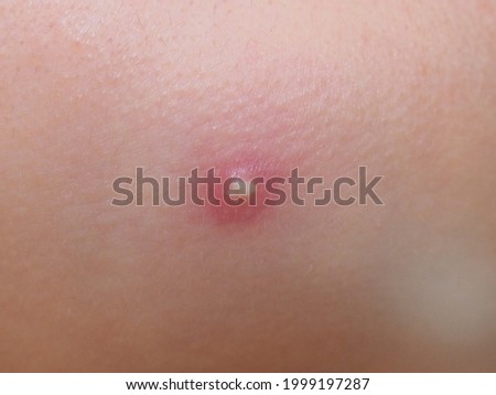 A pustule with yellowish pus surrounded by redness on the base on the clogged pore in the person with oily facial skin  Royalty-Free Stock Photo #1999197287