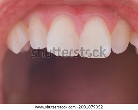 Pale yellow front teeth in macro view with a little bit of plaque on the gum margin