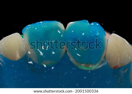acid etching prior to restoration for eroded anterior teeth caused by acid reflux Royalty-Free Stock Photo #2001500336