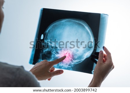 X-ray analysis of head skull image with red pain point in hands of specialist, closeup Royalty-Free Stock Photo #2003899742
