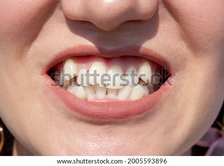 Curved female teeth, before installing braces. Close - up of teeth before treatment by an orthodontist Royalty-Free Stock Photo #2005593896