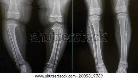 The x-ray show pre-operative and post-operative oblique osteotomy of proximal tibia of Blount's disease (LK II-III) in children. 3 years after surgey is good algnment and normal tibial plateau. Royalty-Free Stock Photo #2005819769