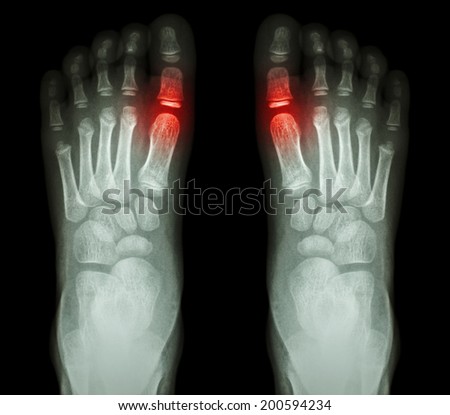 "Rheumatoid arthritis , Gouty arthritis"  X-ray child's foots and arthritis at metatarsophalangeal joint (Big toe area)