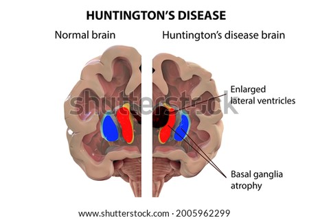 Coronal sections of a healthy brain and a brain in Huntington's disease showing enlarged anterior horns of the lateral ventricles, degeneration and atrophy of the dorsal striatum, 3D illustration