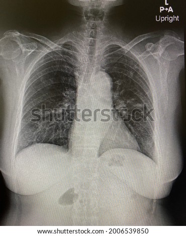 The picture of chest x-ray of patient who have pneumonia in covid-19 patient ,Medical Technology and Science concept.