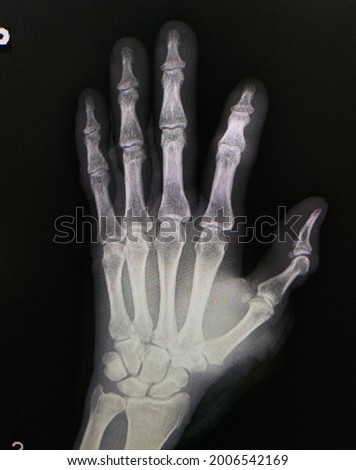 The picture of normal film x-ray right hand, Medical Technology and Science concept.