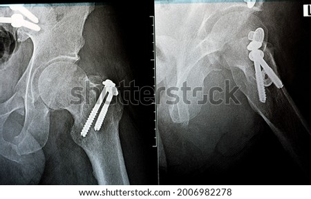 Selective focus of a plain x ray on left hip joined with a fracture of the greater trochanter of femur fixed with 2 screws in an open reduction surgery and a fracture of symphysis pubis after accident Royalty-Free Stock Photo #2006982278