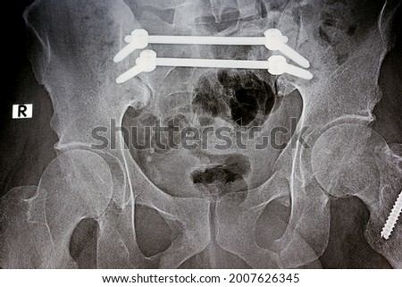 Plain x ray with a fracture pelvis that is fixed with 4 screws and 2 rods and fracture of greater trochanter of femur fixed with 2 screws and fracture of symphysis pubis, ileo-iliac pelvic fixation Royalty-Free Stock Photo #2007626345