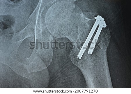 Selective focus of a plain x ray on left hip joined with a fracture of the greater trochanter of femur fixed with 2 screws in an open reduction surgery and a fracture of symphysis pubis after accident Royalty-Free Stock Photo #2007791270