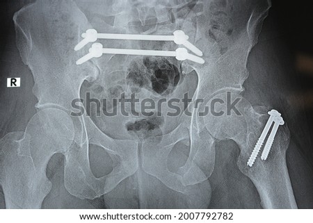 Plain x ray with a fracture pelvis that is fixed with 4 screws and 2 rods and fracture of greater trochanter of femur fixed with 2 screws and fracture of symphysis pubis, ileo-iliac pelvic fixation Royalty-Free Stock Photo #2007792782
