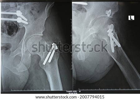 Selective focus of a plain x ray on left hip joined with a fracture of the greater trochanter of femur fixed with 2 screws in an open reduction surgery and a fracture of symphysis pubis after accident Royalty-Free Stock Photo #2007794015